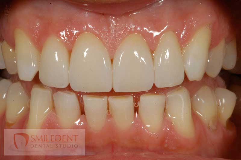 SmileDent Dental Studio | PFM AND FCM Solutions, Aesthetic E-Max Solutions and Surgical Guides
