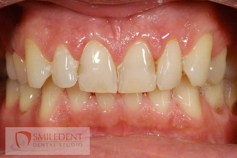 SmileDent Dental Studio | PFM AND FCM Solutions, Aesthetic E-Max Solutions and CHROME trade  GuidedSMILE trade 