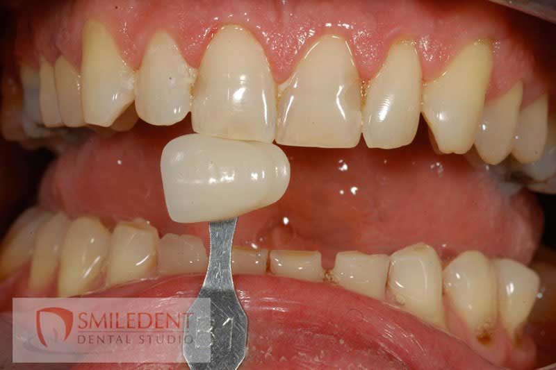 SmileDent Dental Studio | CHROME trade  GuidedSMILE trade , Acrylic Hybrid Solutions and nSequence reg  Protocol 