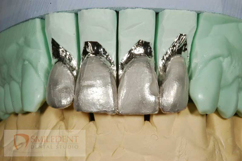 SmileDent Dental Studio | nSequence reg  Protocol , PFM AND FCM Solutions and Prettau Bridge