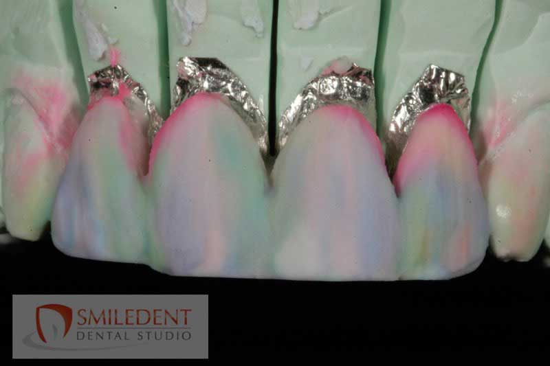 SmileDent Dental Studio | Acrylic Hybrid Solutions, Aesthetic E-Max Solutions and Implant Solutions