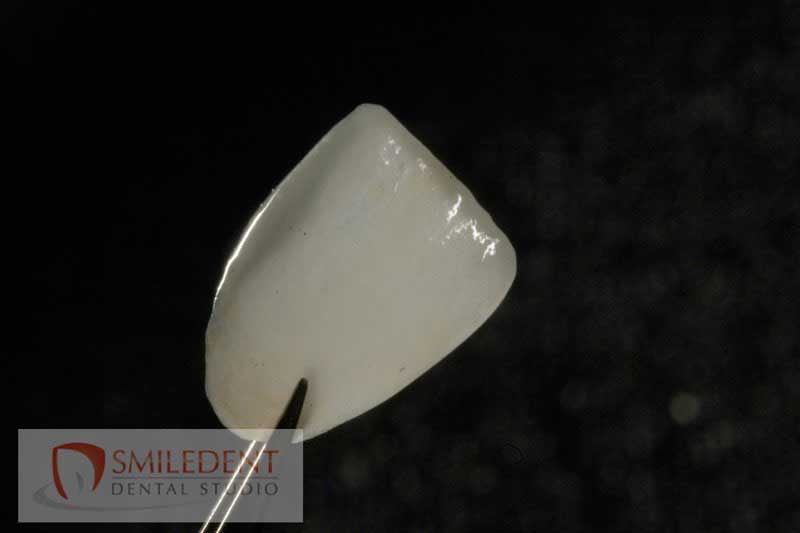 SmileDent Dental Studio | Zirconia, Aesthetic E-Max Solutions and Implant Solutions
