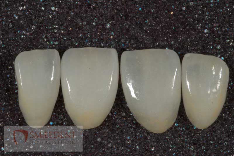 SmileDent Dental Studio | Implant Solutions, Surgical Guides and Aesthetic E-Max Solutions