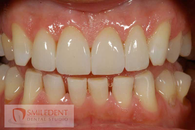 SmileDent Dental Studio | Implant Solutions, CHROME trade  GuidedSMILE trade  and Aesthetic E-Max Solutions
