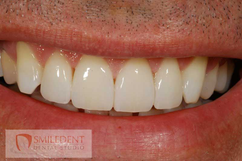SmileDent Dental Studio | PFM AND FCM Solutions, Surgical Guides and Prettau Bridge