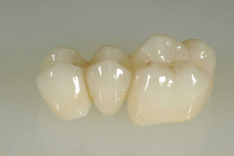 SmileDent Dental Studio | PFM AND FCM Solutions, Aesthetic E-Max Solutions and Surgical Guides