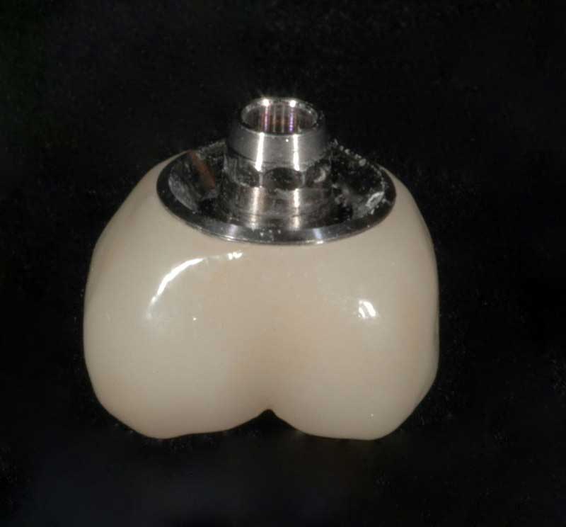 SmileDent Dental Studio | Acrylic Hybrid Solutions, CHROME trade  GuidedSMILE trade  and nSequence reg  Protocol 