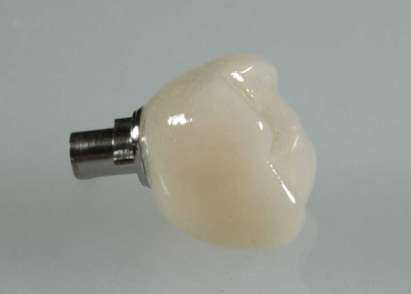 SmileDent Dental Studio | Surgical Guides, Prettau Bridge and Implant Solutions