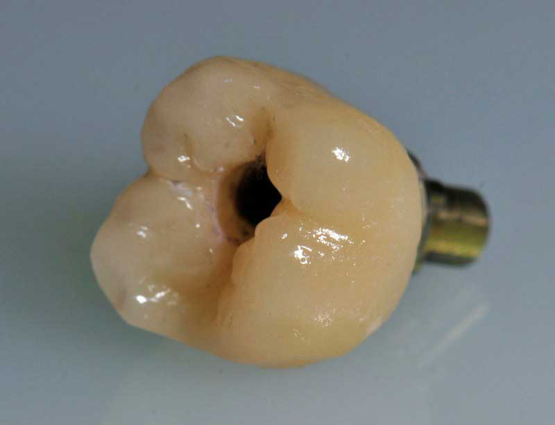 SmileDent Dental Studio | Surgical Guides, nSequence reg  Protocol  and Aesthetic E-Max Solutions