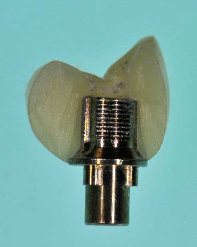 SmileDent Dental Studio | Aesthetic E-Max Solutions, Prettau Bridge and Implant Solutions