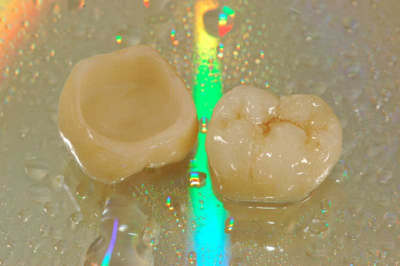 SmileDent Dental Studio | Implant Solutions, CHROME trade  GuidedSMILE trade  and Aesthetic E-Max Solutions