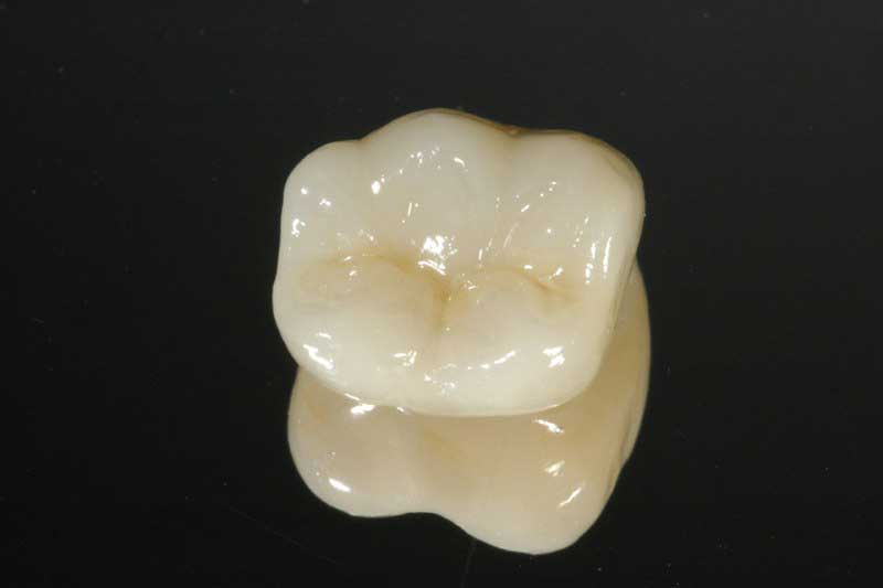 SmileDent Dental Studio | PFM AND FCM Solutions, Surgical Guides and Prettau Bridge