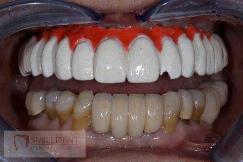 SmileDent Dental Studio | nSequence reg  Protocol , CHROME trade  GuidedSMILE trade  and Prettau Bridge