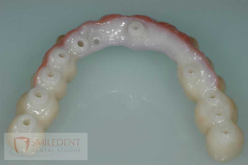 SmileDent Dental Studio | PFM AND FCM Solutions, Aesthetic E-Max Solutions and Surgical Guides