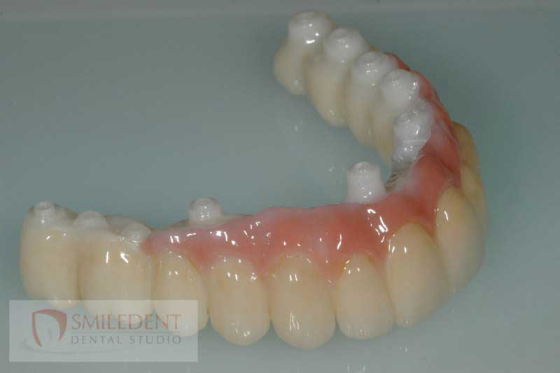 SmileDent Dental Studio | Prettau Bridge, Aesthetic E-Max Solutions and PFM AND FCM Solutions