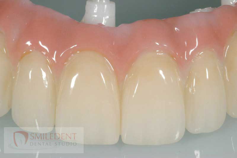 SmileDent Dental Studio | Acrylic Hybrid Solutions, CHROME trade  GuidedSMILE trade  and nSequence reg  Protocol