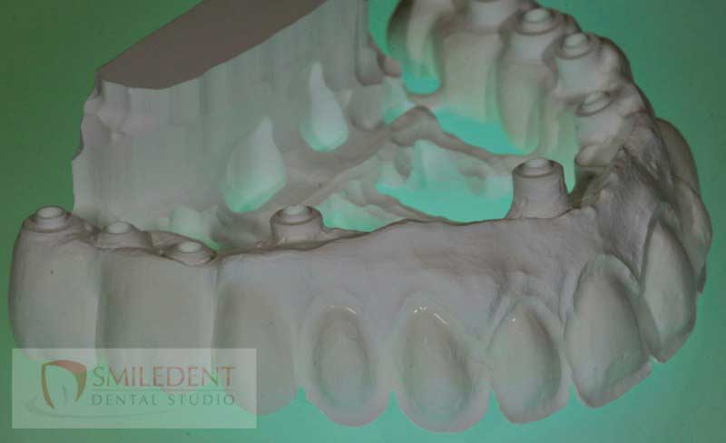 SmileDent Dental Studio | PFM AND FCM Solutions, Aesthetic E-Max Solutions and CHROME trade  GuidedSMILE trade 