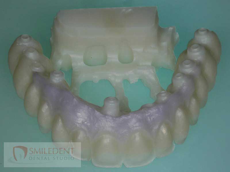 SmileDent Dental Studio | CHROME trade  GuidedSMILE trade , Acrylic Hybrid Solutions and nSequence reg  Protocol