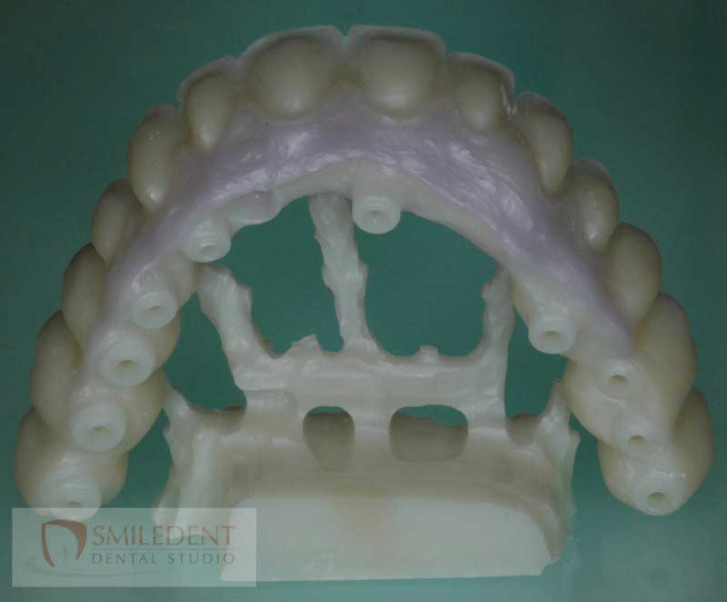 SmileDent Dental Studio | nSequence reg  Protocol , PFM AND FCM Solutions and Prettau Bridge