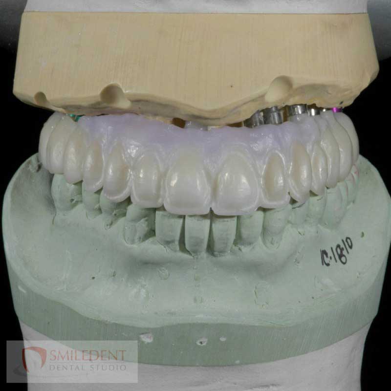 SmileDent Dental Studio | Acrylic Hybrid Solutions, Aesthetic E-Max Solutions and Implant Solutions