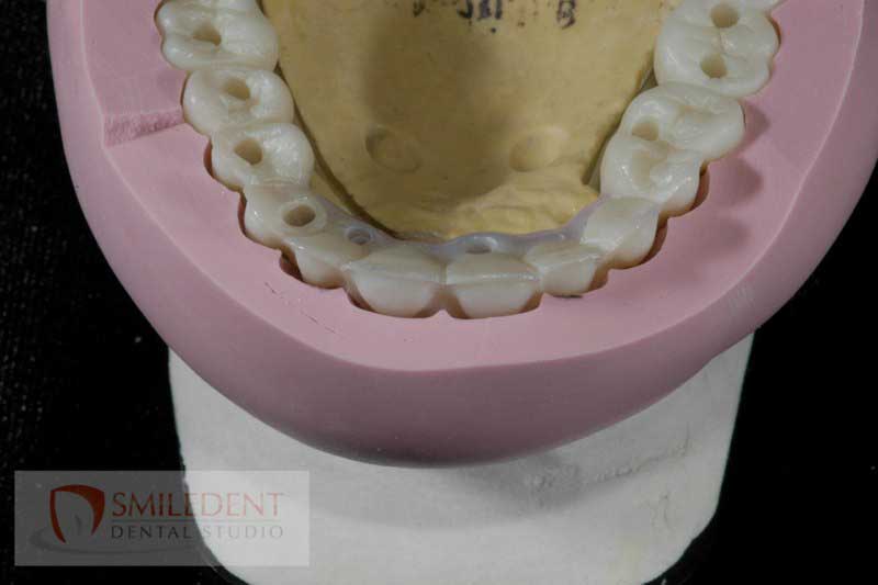 SmileDent Dental Studio | Zirconia, Aesthetic E-Max Solutions and Implant Solutions