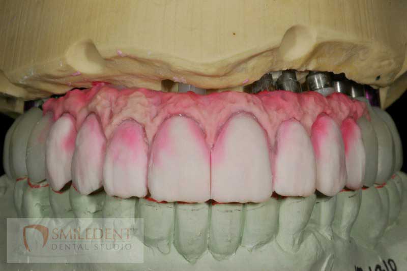SmileDent Dental Studio | Implant Solutions, Surgical Guides and Aesthetic E-Max Solutions