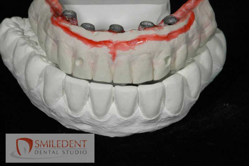 SmileDent Dental Studio | nSequence reg  Protocol , CHROME trade  GuidedSMILE trade  and Prettau Bridge