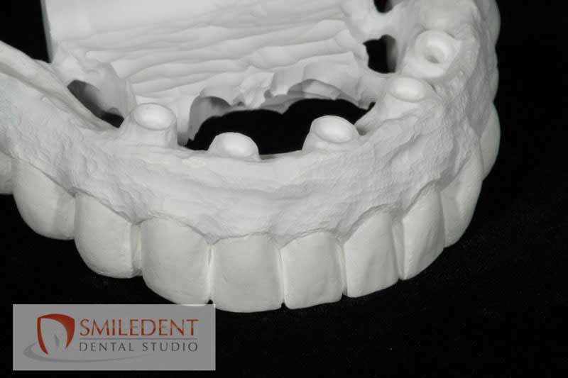 SmileDent Dental Studio | CHROME trade  GuidedSMILE trade , Acrylic Hybrid Solutions and nSequence reg  Protocol 