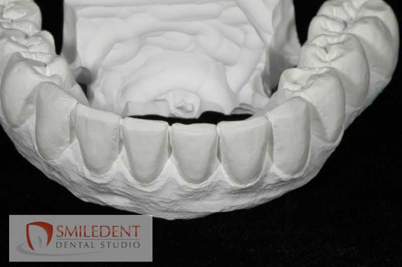 SmileDent Dental Studio | nSequence reg  Protocol , PFM AND FCM Solutions and Prettau Bridge
