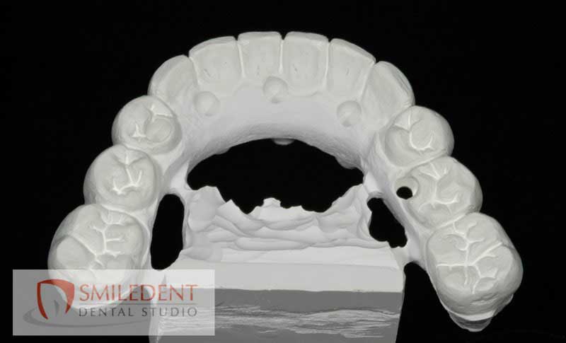 SmileDent Dental Studio | Acrylic Hybrid Solutions, Aesthetic E-Max Solutions and Implant Solutions