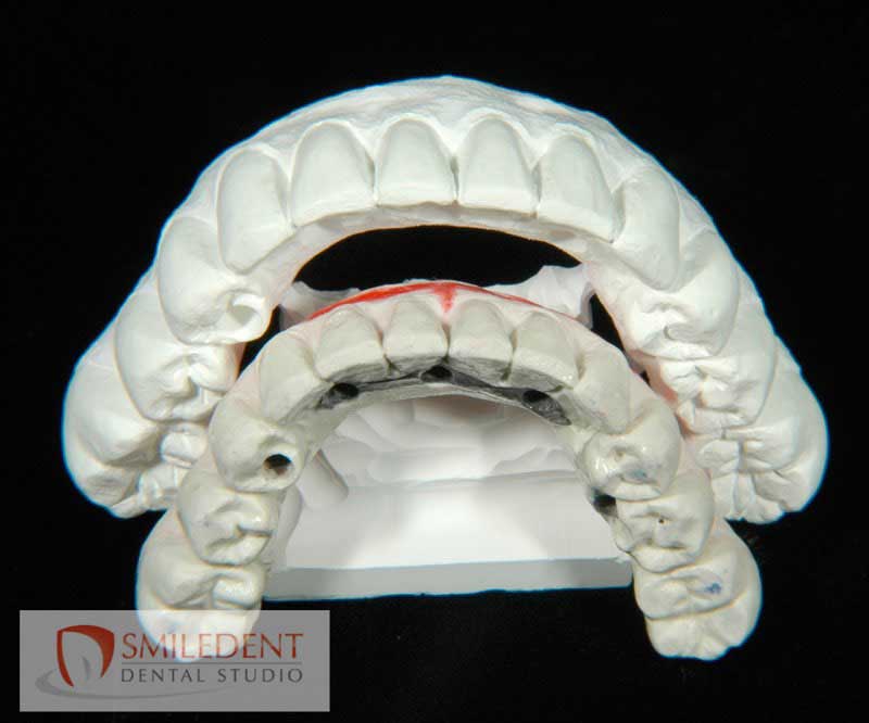 SmileDent Dental Studio | Zirconia, Aesthetic E-Max Solutions and Implant Solutions