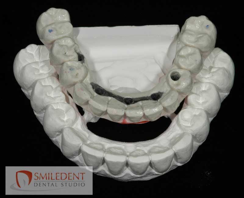 SmileDent Dental Studio | Implant Solutions, Surgical Guides and Aesthetic E-Max Solutions