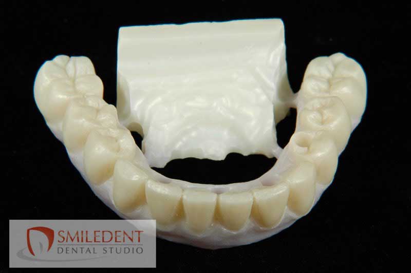 SmileDent Dental Studio | PFM AND FCM Solutions, Surgical Guides and Prettau Bridge