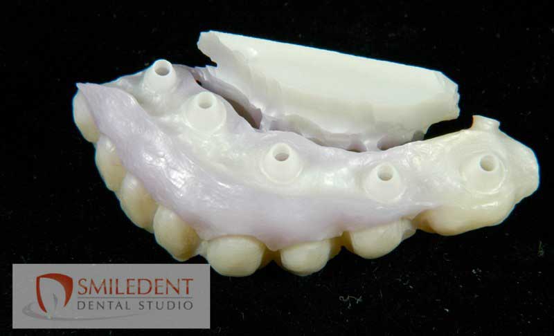 SmileDent Dental Studio | nSequence reg  Protocol , CHROME trade  GuidedSMILE trade  and Prettau Bridge