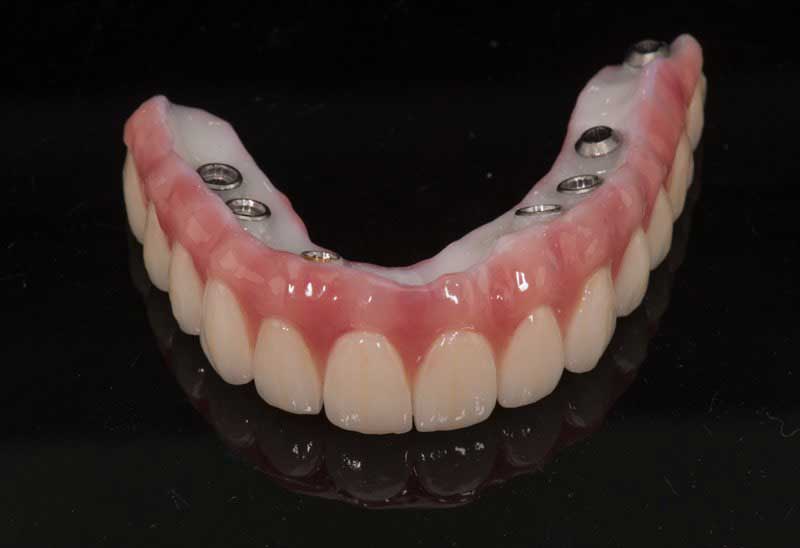 SmileDent Dental Studio | Prettau Bridge, CHROME trade  GuidedSMILE trade  and Implant Solutions