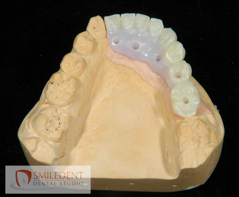 SmileDent Dental Studio | PFM AND FCM Solutions, Aesthetic E-Max Solutions and CHROME trade  GuidedSMILE trade 