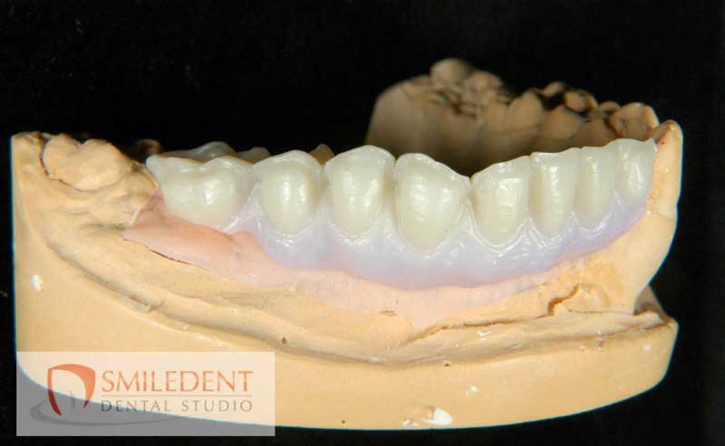 SmileDent Dental Studio | CHROME trade  GuidedSMILE trade , Acrylic Hybrid Solutions and nSequence reg  Protocol 