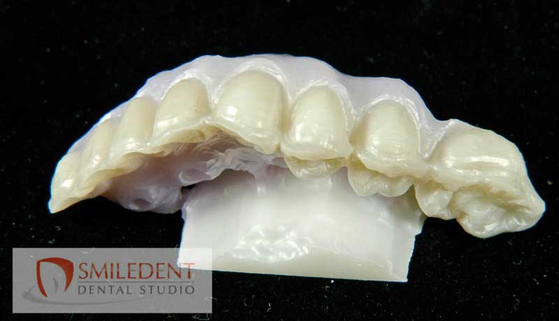 SmileDent Dental Studio | nSequence reg  Protocol , PFM AND FCM Solutions and Prettau Bridge
