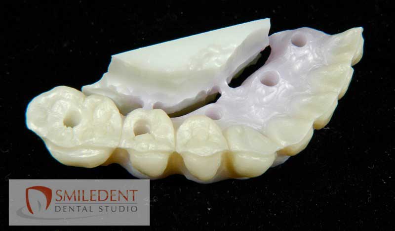 SmileDent Dental Studio | Acrylic Hybrid Solutions, Aesthetic E-Max Solutions and Implant Solutions