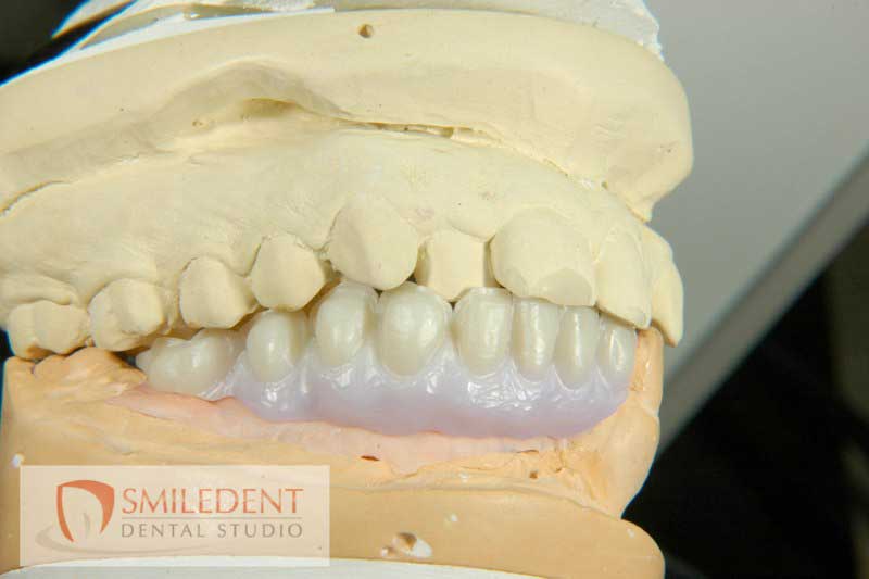 SmileDent Dental Studio | Zirconia, Aesthetic E-Max Solutions and Implant Solutions