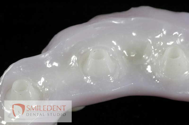 SmileDent Dental Studio | Implant Solutions, Surgical Guides and Aesthetic E-Max Solutions