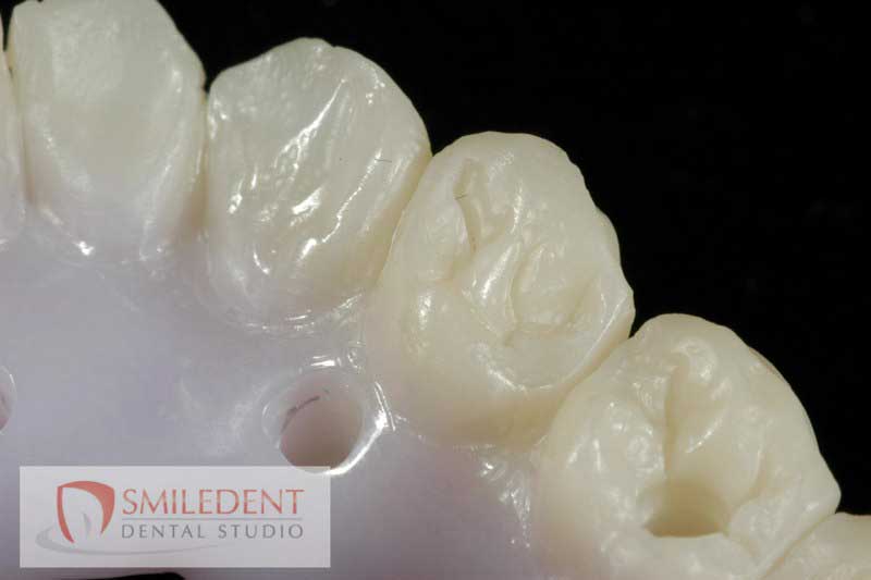 SmileDent Dental Studio | Implant Solutions, CHROME trade  GuidedSMILE trade  and Aesthetic E-Max Solutions