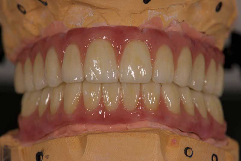 SmileDent Dental Studio | PFM AND FCM Solutions, Surgical Guides and Prettau Bridge