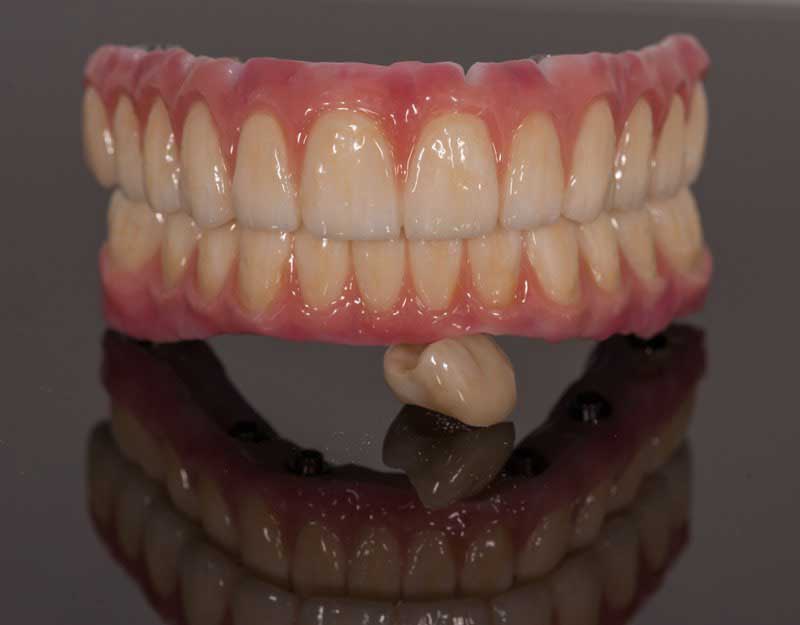 SmileDent Dental Studio | nSequence reg  Protocol , CHROME trade  GuidedSMILE trade  and Prettau Bridge