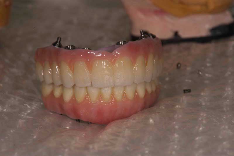 SmileDent Dental Studio | PFM AND FCM Solutions, Aesthetic E-Max Solutions and Surgical Guides