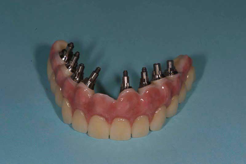 SmileDent Dental Studio | Prettau Bridge, Aesthetic E-Max Solutions and PFM AND FCM Solutions
