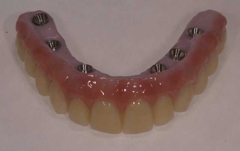 SmileDent Dental Studio | Acrylic Hybrid Solutions, CHROME trade  GuidedSMILE trade  and nSequence reg  Protocol 