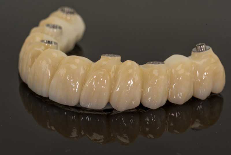 SmileDent Dental Studio | Prettau Bridge, CHROME trade  GuidedSMILE trade  and Implant Solutions