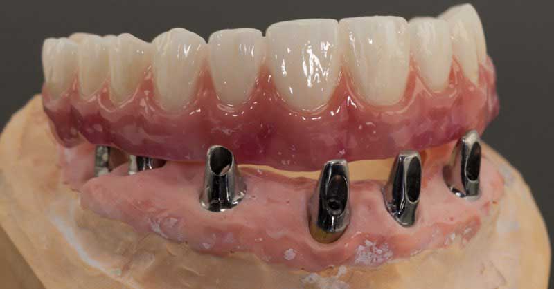 SmileDent Dental Studio | Surgical Guides, Prettau Bridge and Implant Solutions