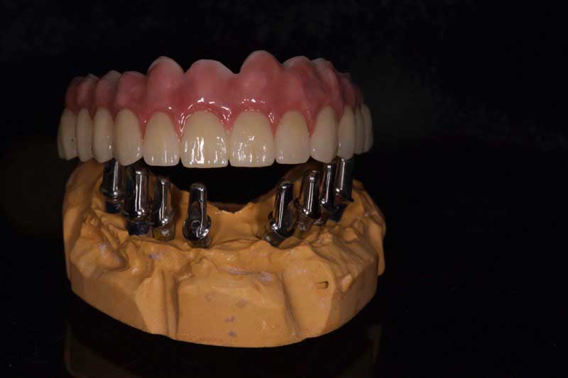 SmileDent Dental Studio | Surgical Guides, nSequence reg  Protocol  and Aesthetic E-Max Solutions